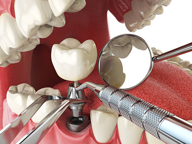 Best Emergency Root Canal Treatment in Everman, TX